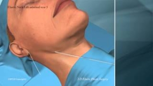 Elastic_Plastic_surgery_Elasticum_suture_3d-elastic-neck-lift-minimal-scar