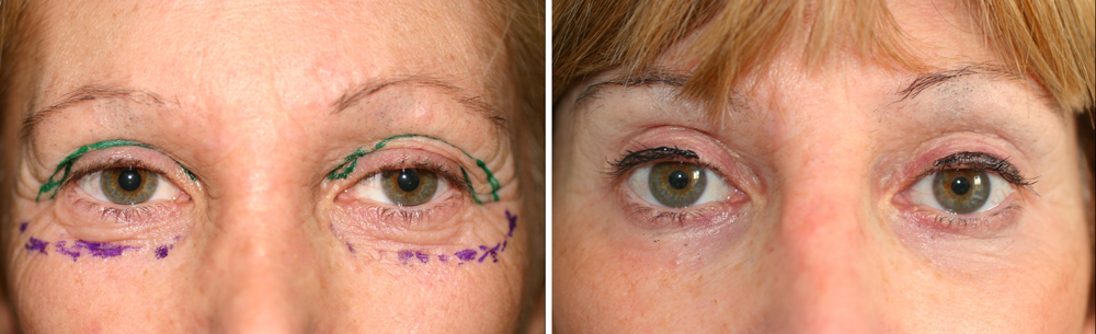 Blepharoplasty by means of rapid pulsed cutting and mixed peeling of eyelid wrinkles and crows’ feet