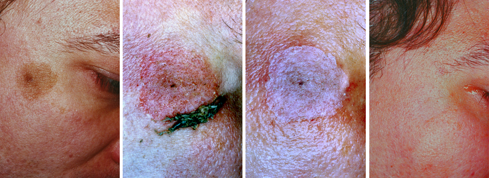 Elimination of a dermal patch by means of mixed timedsurgical peeling