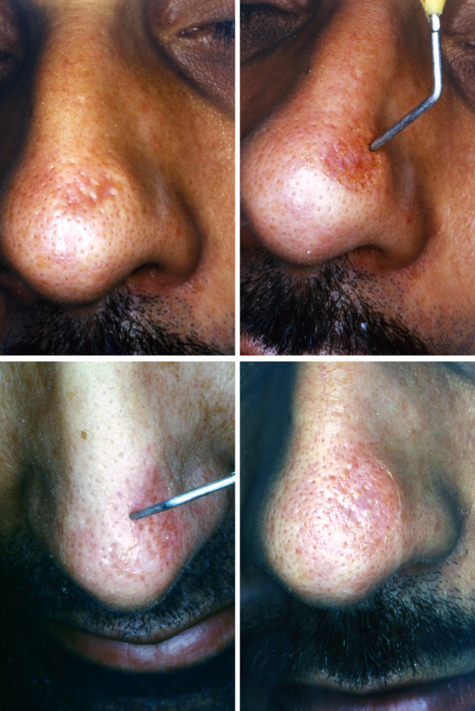 Levelling an area of scarring by means of timedsurgical resurfacing.