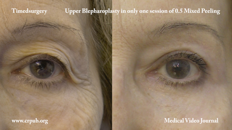 Non surgical Upper Blepharoplasty