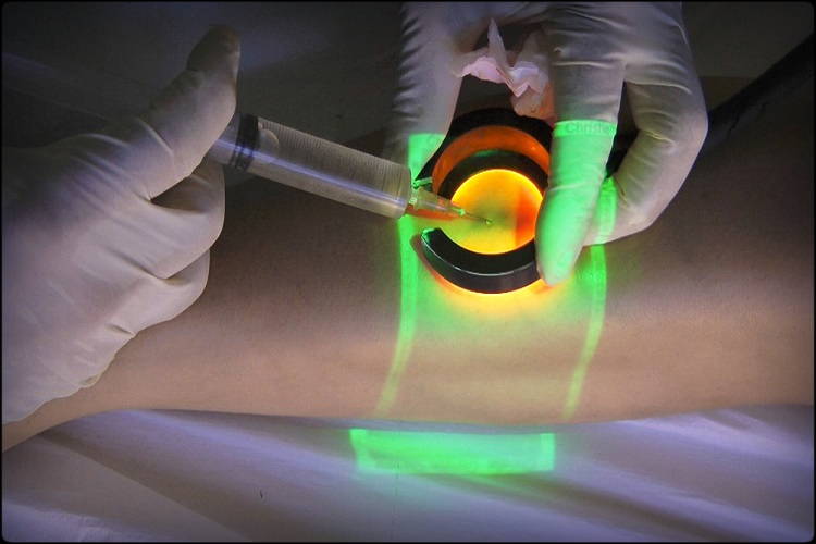 Phlebotherapy_TRAP_vein_light_e_vein_viewer_corsi_Korpo